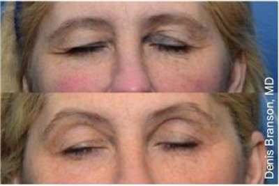 Before and After ThermiSmooth Skin Smoothing Dallas
