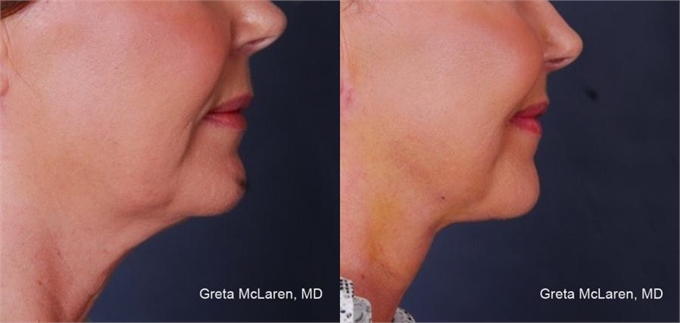 Before and After ThermiTight Skin Tightening Laser 