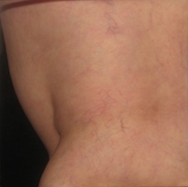Sclerotherapy After Asclera