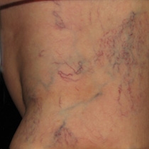 Sclerotherapy Before Asclera