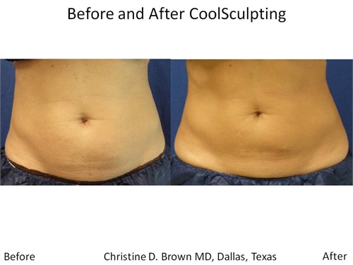 Coolsculpting Dallas Before and After