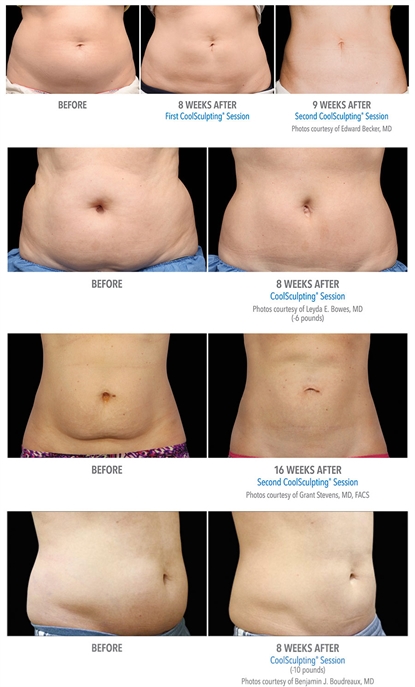Before and After CoolSculpting images