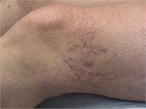 Sclerotherapy Before Varicose Veins