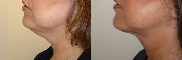 Before and After ThermiTight Skin Tightening Laser