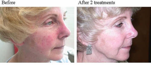 before and after IPL photorejuvenation