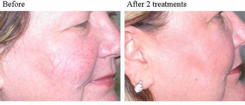 before and after IPL photorejuvenation 2