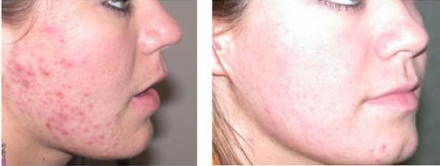 before and after IPL photorejuvenation 3