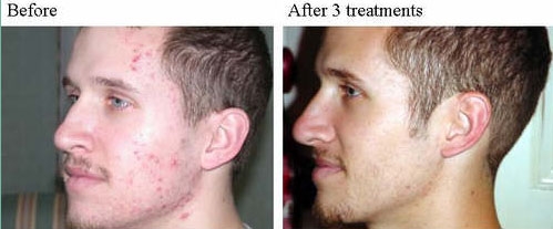 before and after IPL photorejuvenation 5