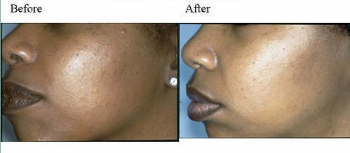 before and after chemical peels