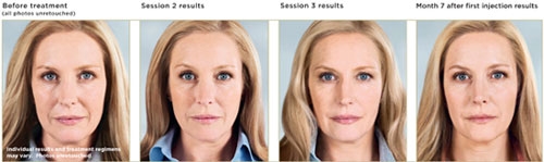 Sculptra Before to After Photos