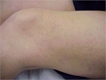 sclerotherapy after