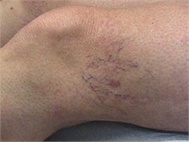 sclerotherapy before